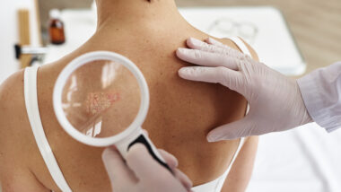 Cancer de la peau : les gestes simples qui peuvent sauver des vies cet été !