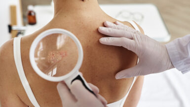 Cancer de la peau : les gestes simples qui peuvent sauver des vies cet été !