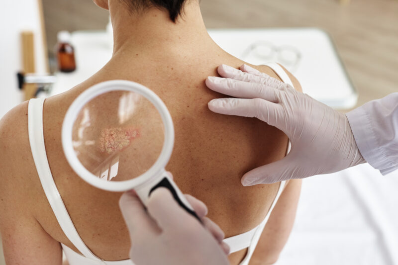 Cancer de la peau : les gestes simples qui peuvent sauver des vies cet été !