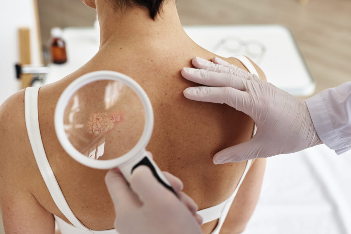 Cancer de la peau : les gestes simples qui peuvent sauver des vies cet été !